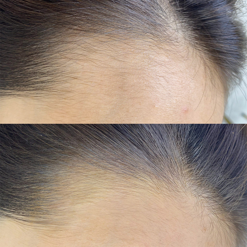 症例用画像_ヘアライン1